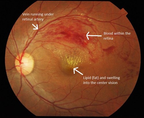 A clot (blockage) of the central vein of the retina