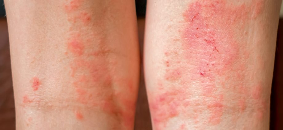 A comfortable life with atopic dermatitis and psoriasis