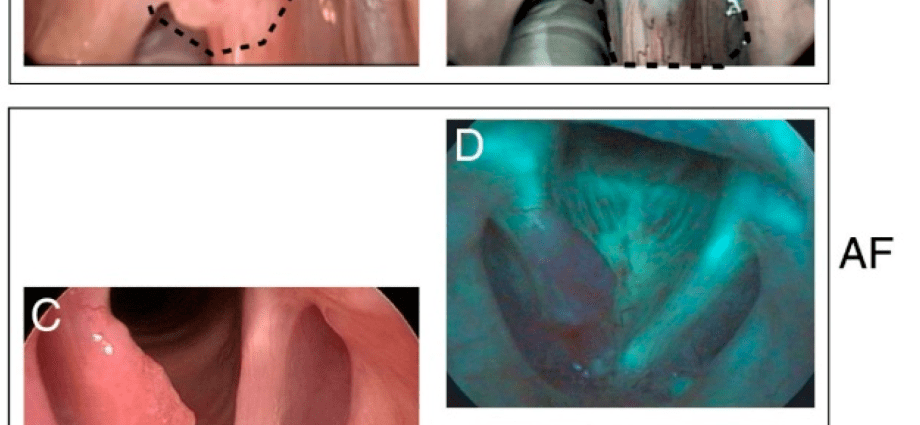 A computer program can detect laryngeal cancer