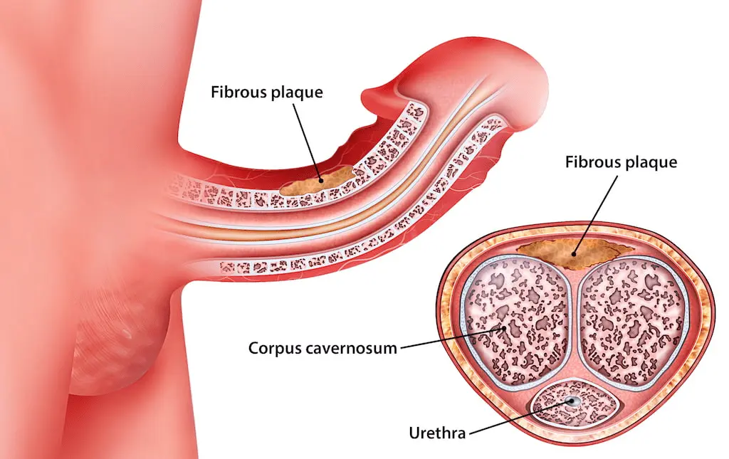 A crooked penis and Peyronie&#8217;s disease. Penis self-examination