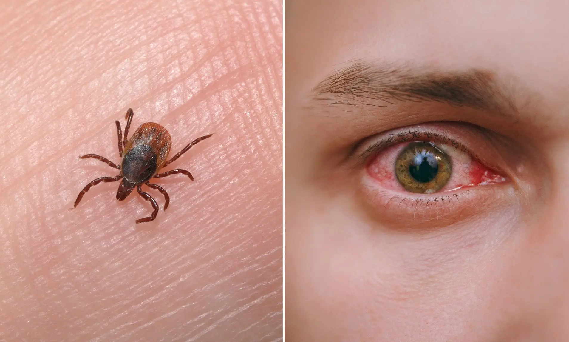 A fever of bleeding eyes near Poland. Ticks carry it