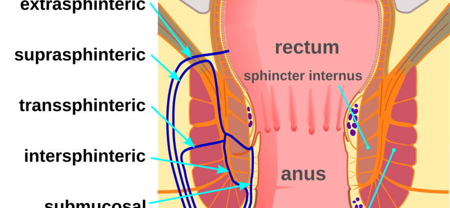 A fistula &#8211; what is it exactly and where does it occur?