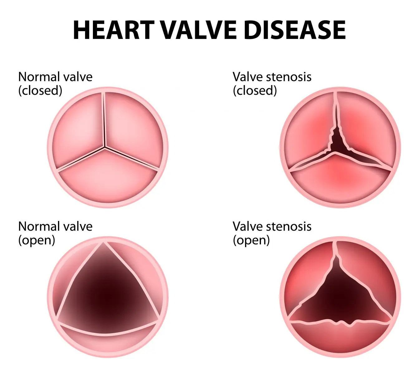 A heart murmur? Causes and symptoms of heart murmurs