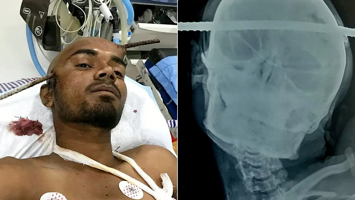 A metal rod pierced his skull. He survived, but became someone else