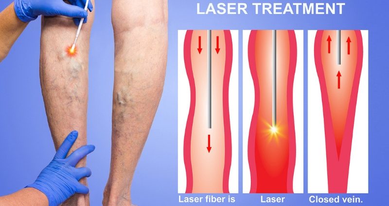 A modern method of removing varicose veins &#8211; what is it?