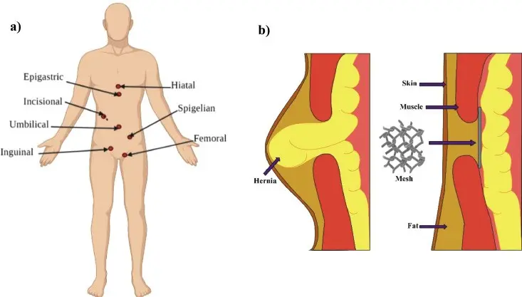 A new method of treating a hernia. It will be cheaper and shorter