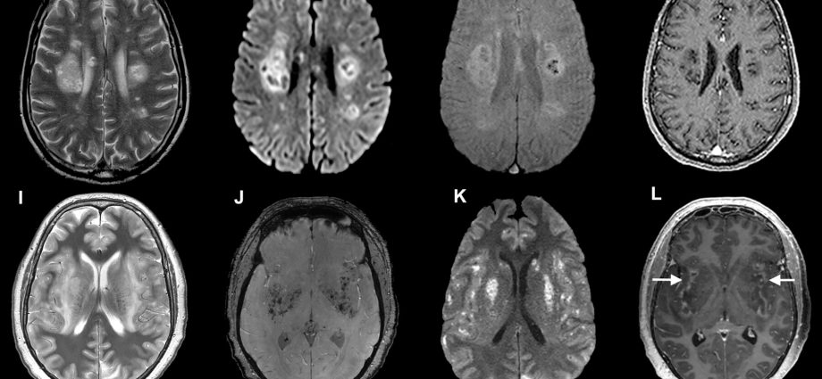 A new study shows how the coronavirus attacks the brain