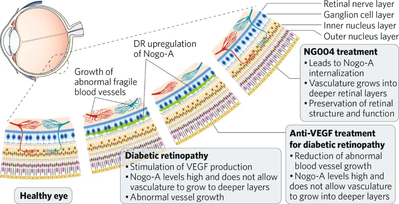 A new way to treat diabetic retinopathy