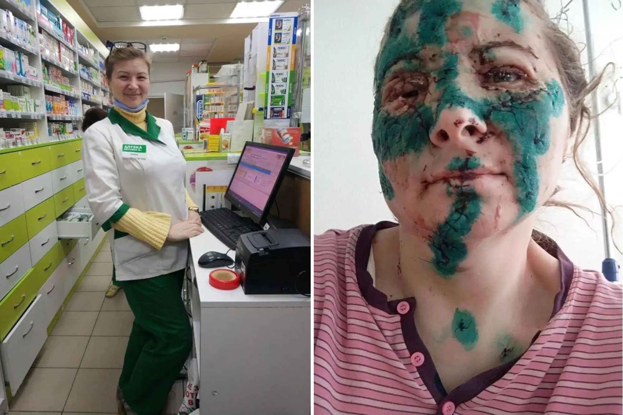 A pharmacist from Kharkiv survived the bombing. Works despite severe facial injuries