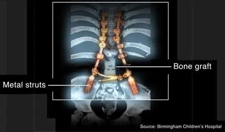 A pioneering spine surgery using leg bones