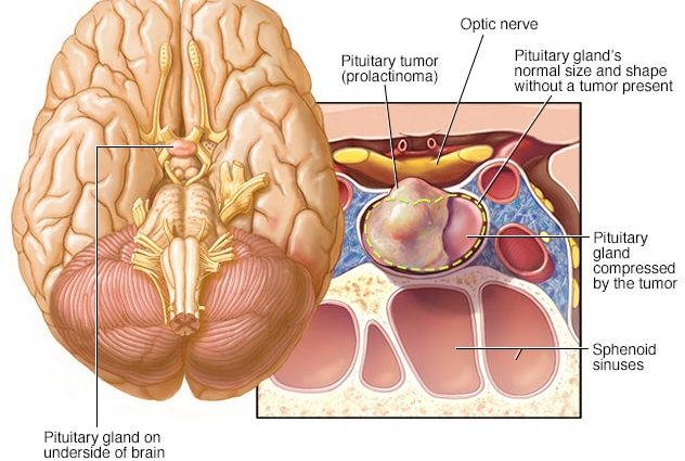 A prolactin tumor