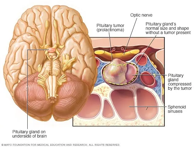 A prolactin tumor