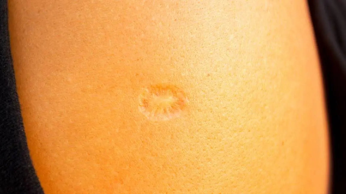 A scar on the arm &#8211; we all have one. Where did it come from?