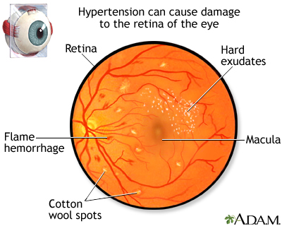 A sign that your blood pressure is too high. It appears in the eyes