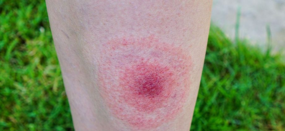 A simple rash? Not necessarily. It could be a tick