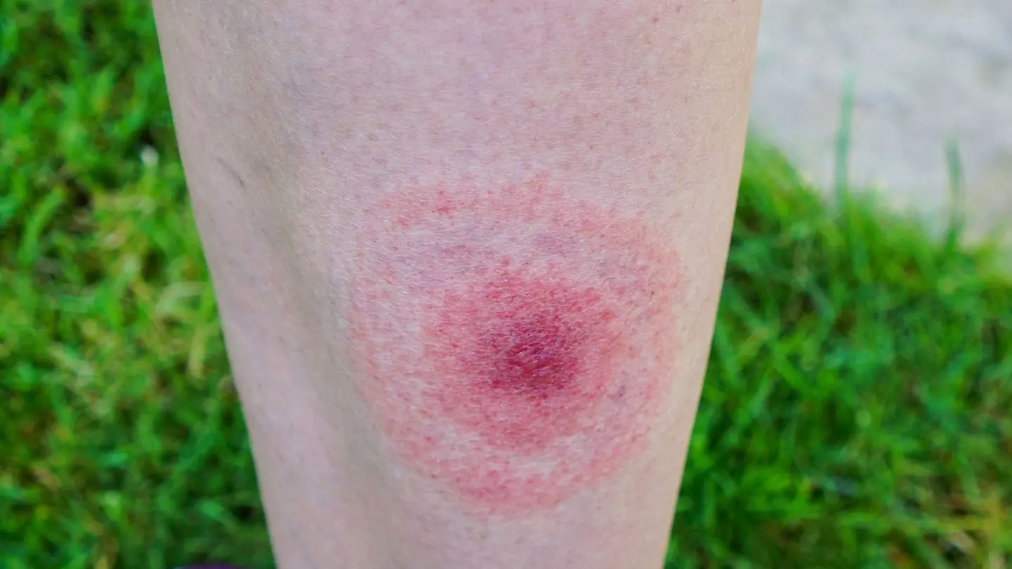 A simple rash? Not necessarily. It could be a tick