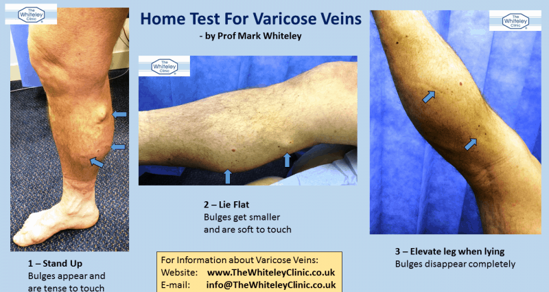 A simple test will tell you if you have varicose veins. You will make it at home