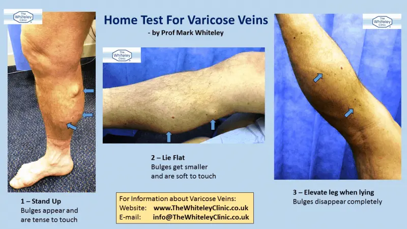 A simple test will tell you if you have varicose veins. You will make it at home