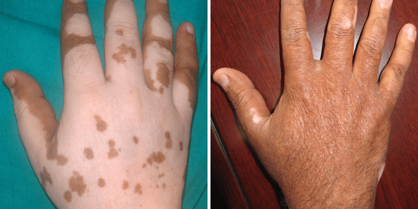 A skin cell transplant can help people with vitiligo