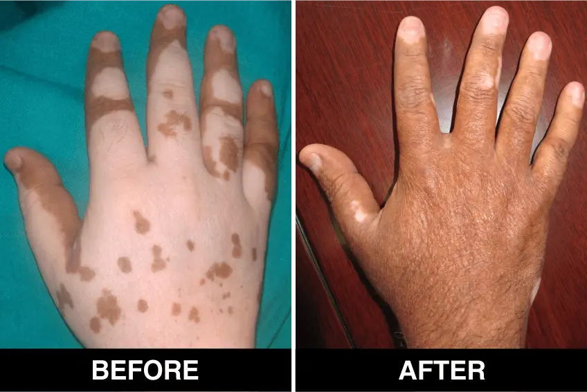 A skin cell transplant can help people with vitiligo