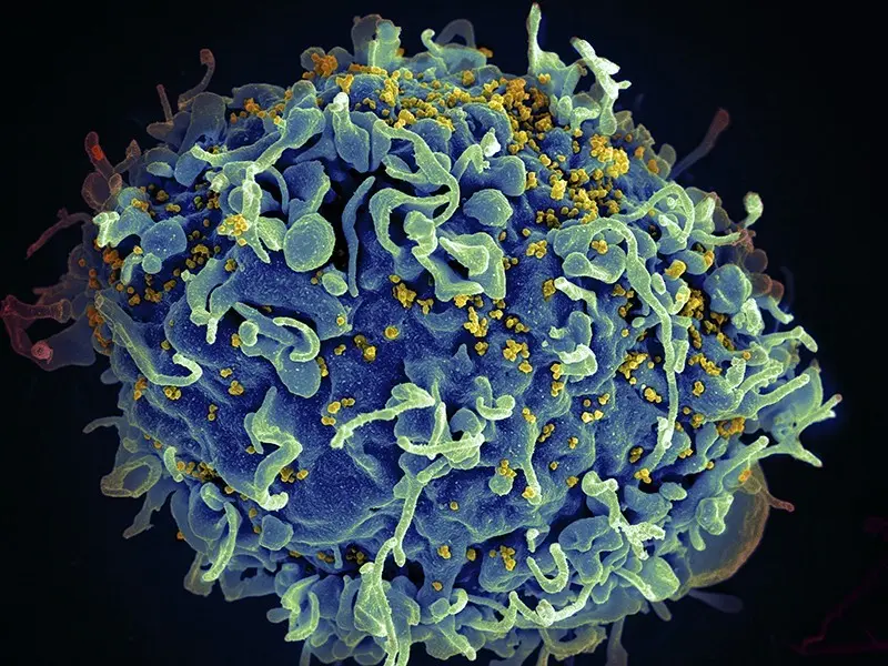 A stem cell transplant could prove to be a cure for HIV. Another patient was freed from the virus thanks to this method