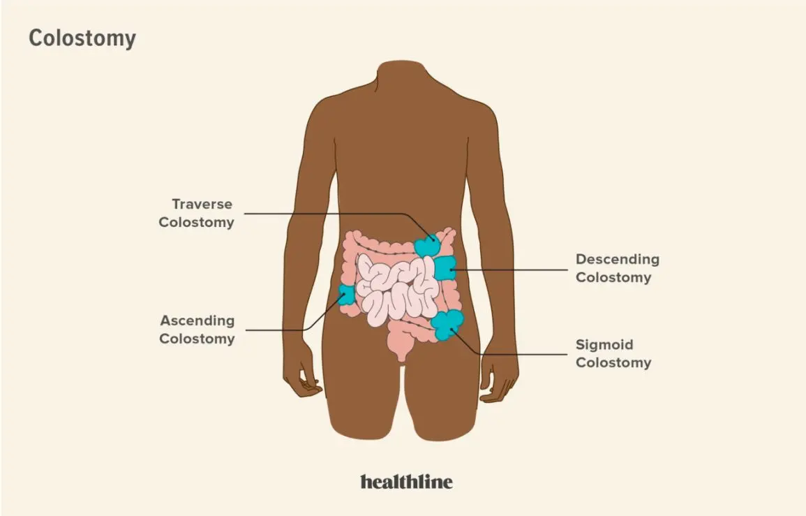 A stoma &#8211; what it is, its types and what problems it can cause