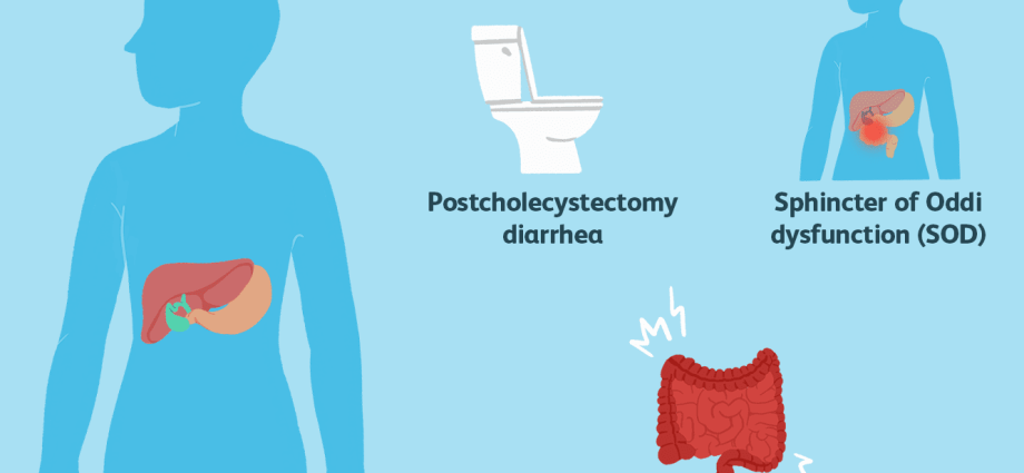 A syndrome of ailments after gallbladder resection