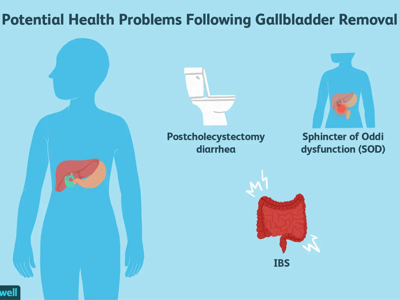 A syndrome of ailments after gallbladder resection