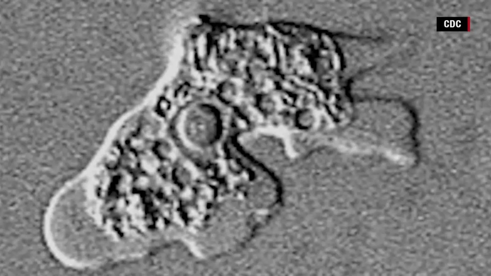 A teenager has been infected with an amoeba that devours the brain