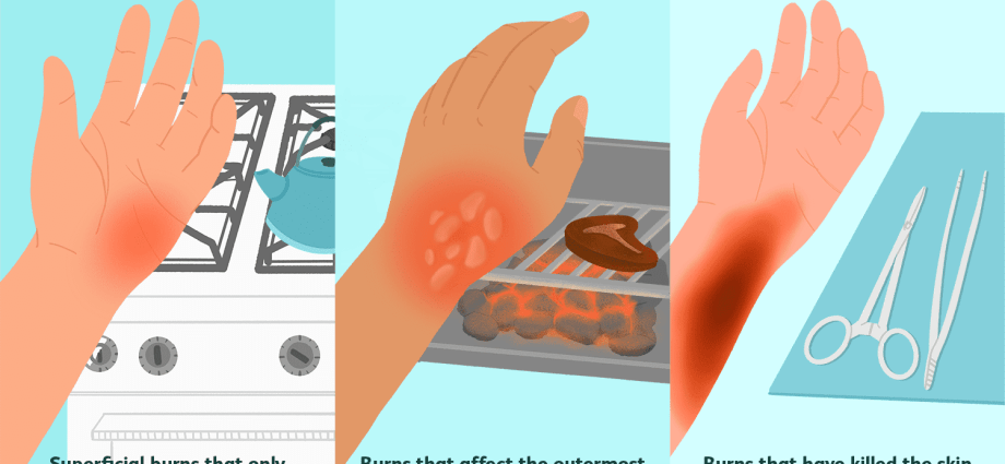 A thermal burn is different from a sunburn. These methods won&#8217;t work