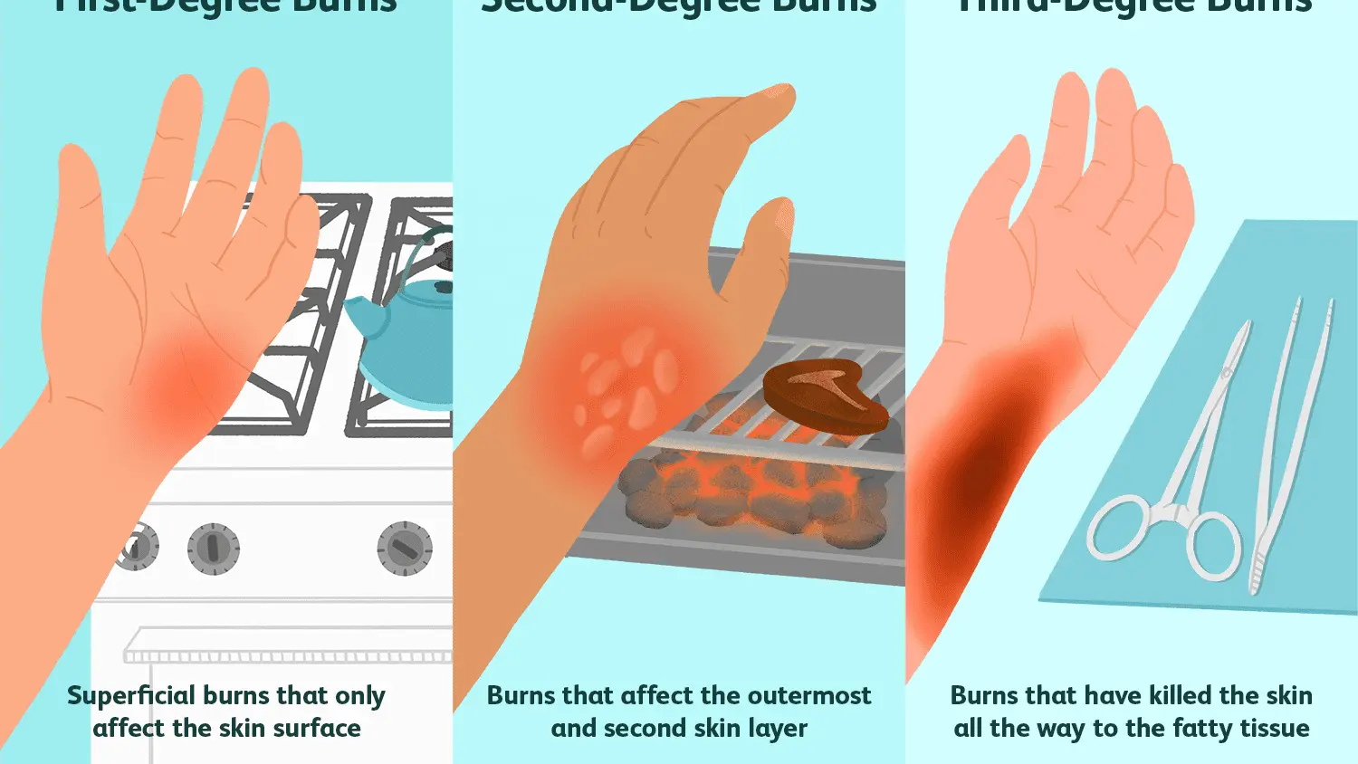 A thermal burn is different from a sunburn. These methods won&#8217;t work