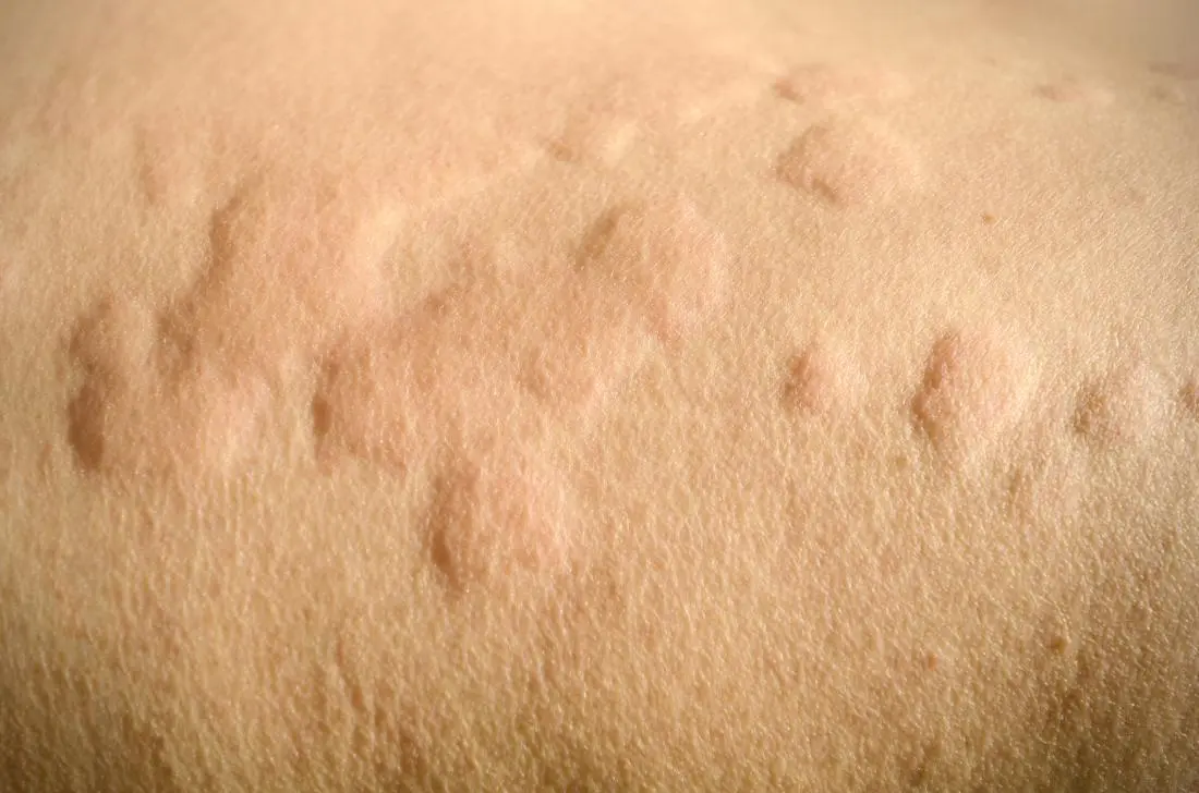 A way to deal with skin allergies