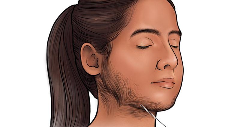 A woman with a beard &#8211; where does hirsutism come from, how to treat it?