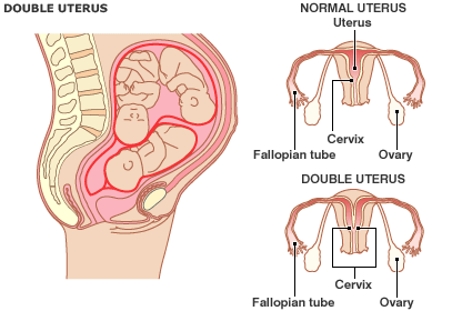 A woman with two uterus gave birth to triplets