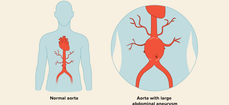 Abdominal aortic aneurysm &#8211; causes, symptoms, treatment