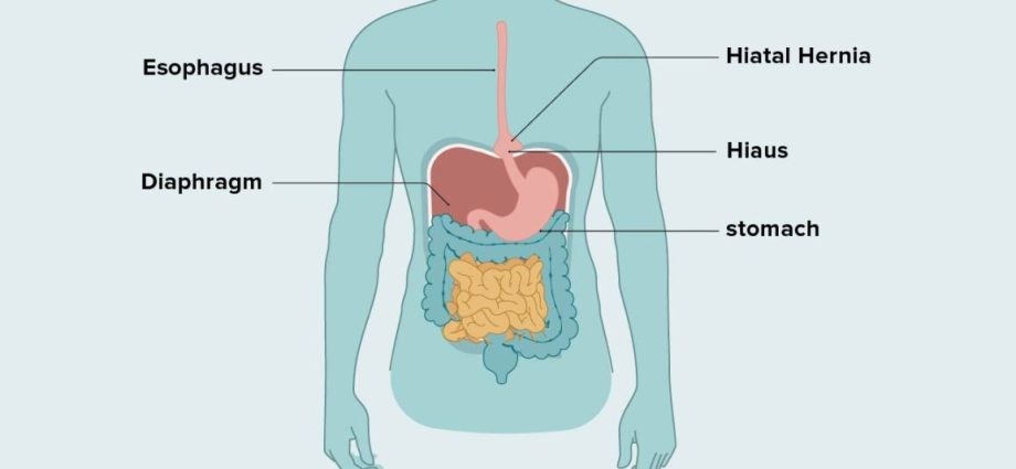 Abdominal hernia &#8211; types, causes, diagnosis, treatment. How can a hernia manifest? WE EXPLAIN