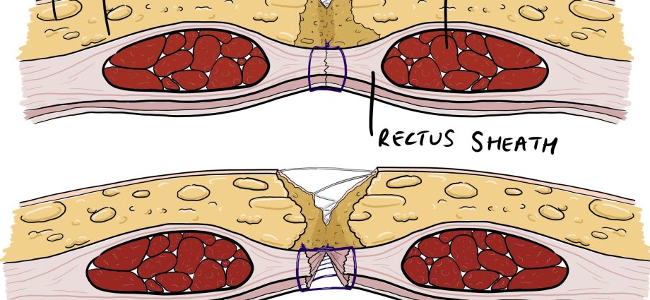 Abdominal muscle dehiscence &#8211; causes, symptoms, treatment methods