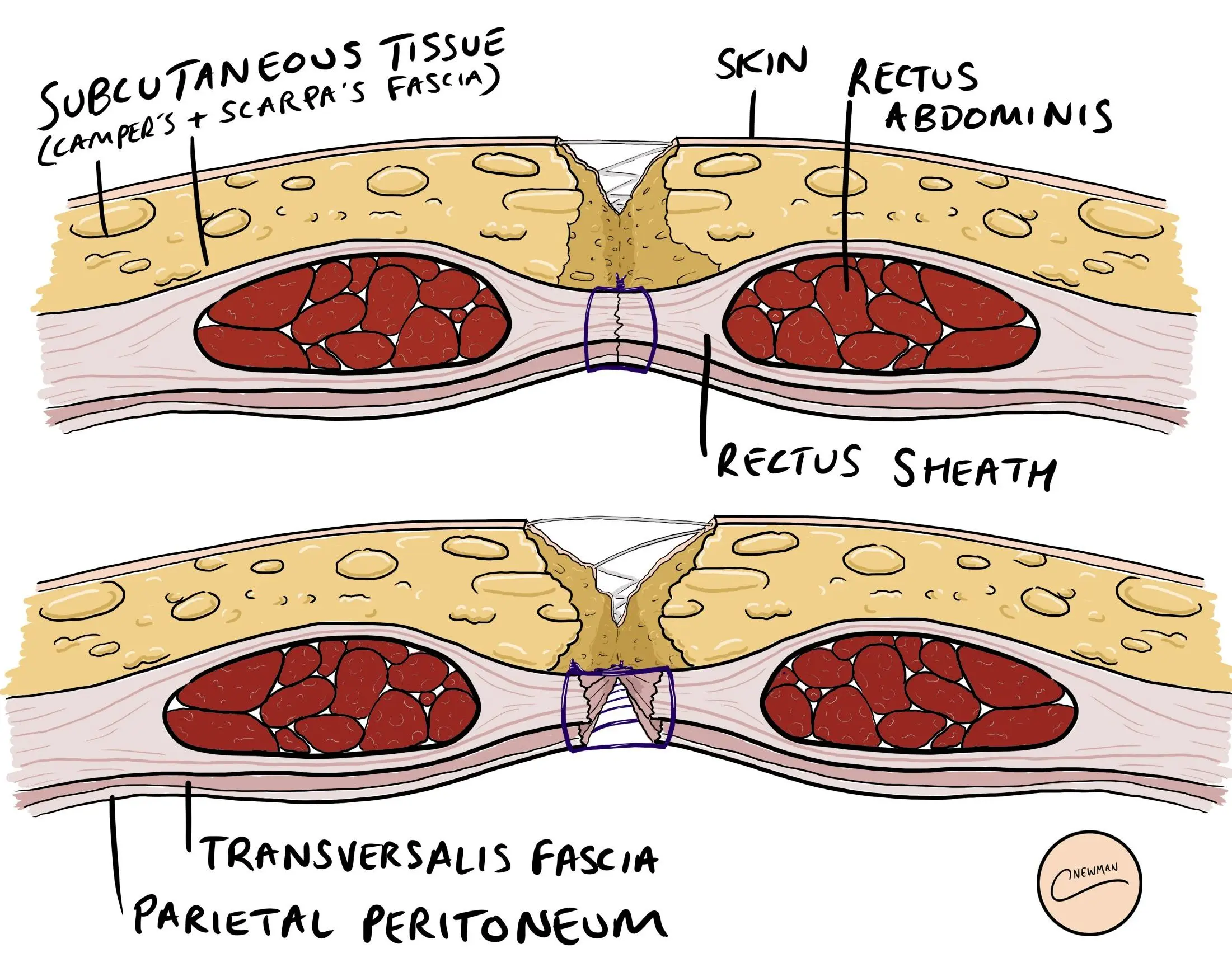 Abdominal muscle dehiscence &#8211; causes, symptoms, treatment methods