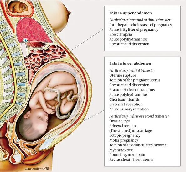 Abdominal pain in pregnancy