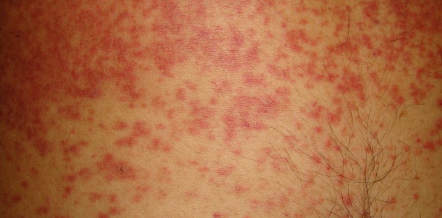 Abdominal rash and the course of infectious diseases. How do you recognize the cause of a rash?