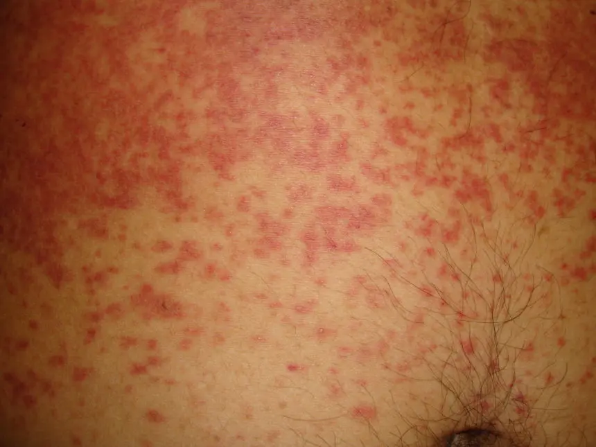 Abdominal rash and the course of infectious diseases. How do you recognize the cause of a rash?