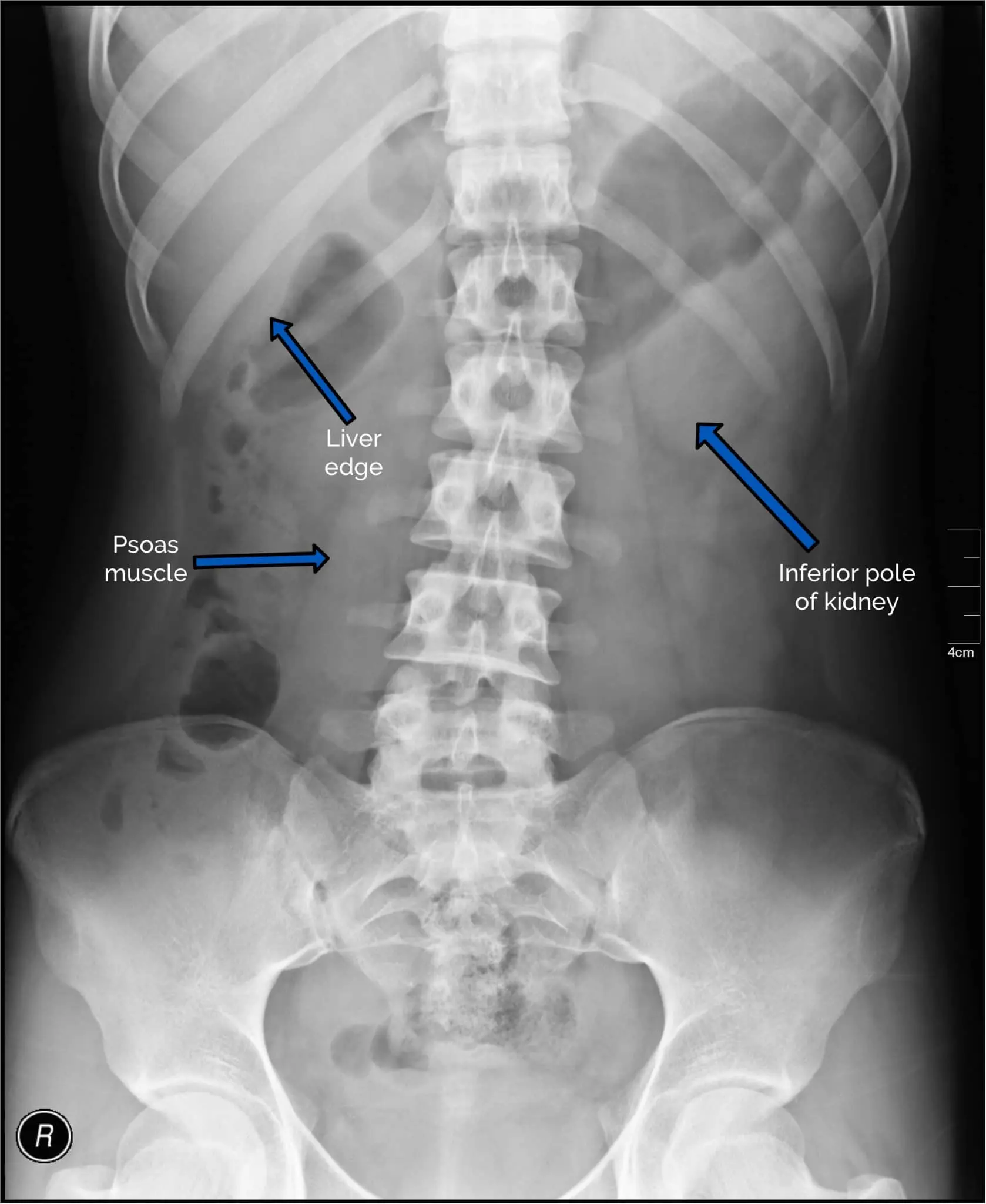 Abdominal X-ray &#8211; how to interpret the results?