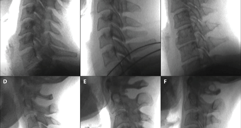 Abolition of cervical lordosis. What is it and how is it treated?