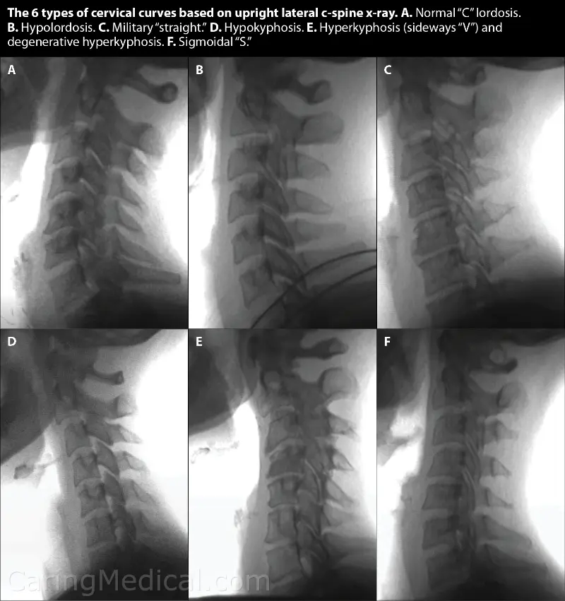 Abolition of cervical lordosis. What is it and how is it treated?