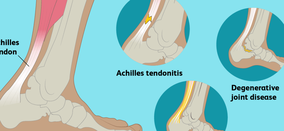 Achilles tendinitis &#8211; causes, symptoms, treatment, prevention. Injury difficult to heal