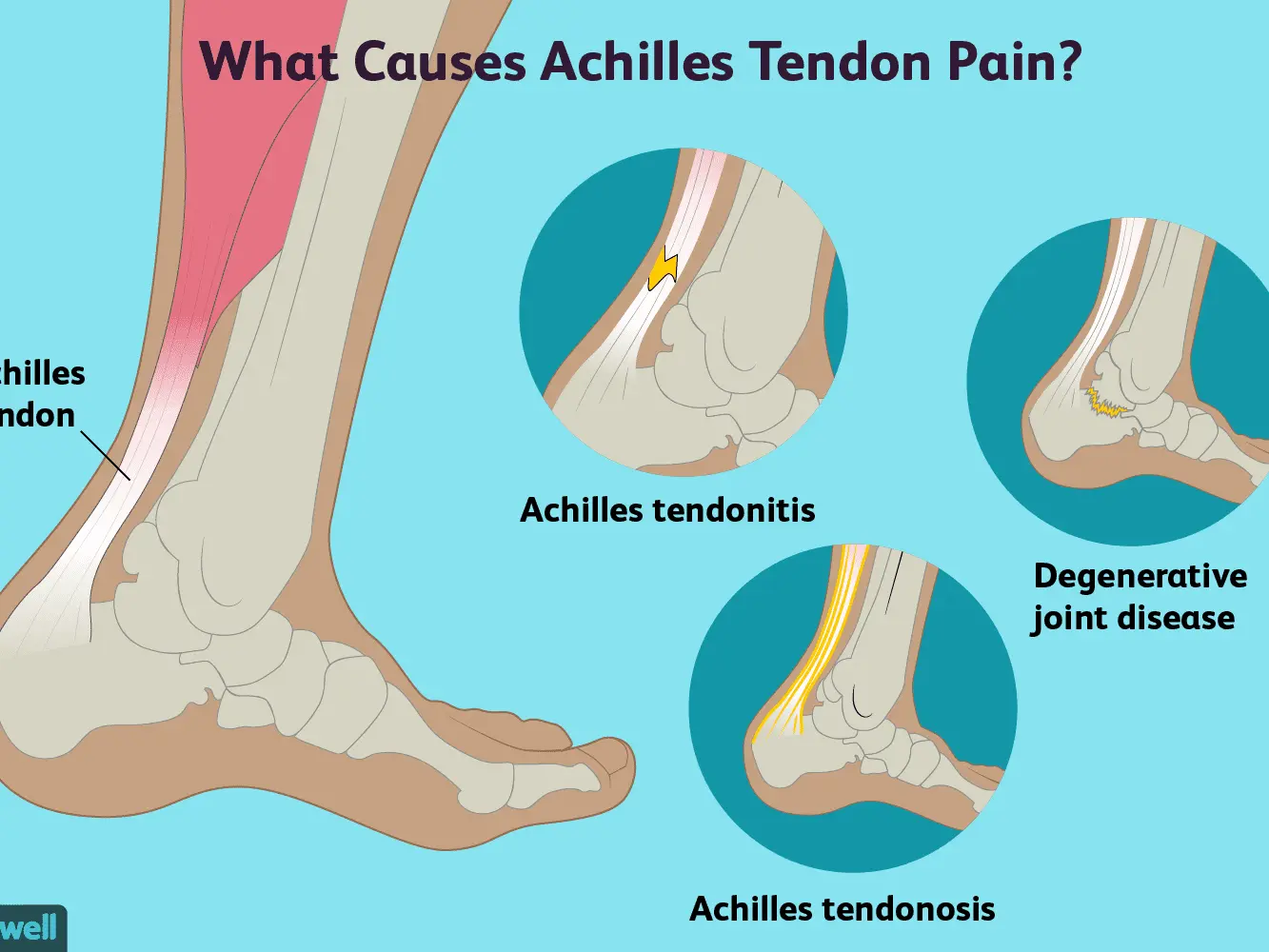 Achilles tendinitis &#8211; causes, symptoms, treatment, prevention. Injury difficult to heal