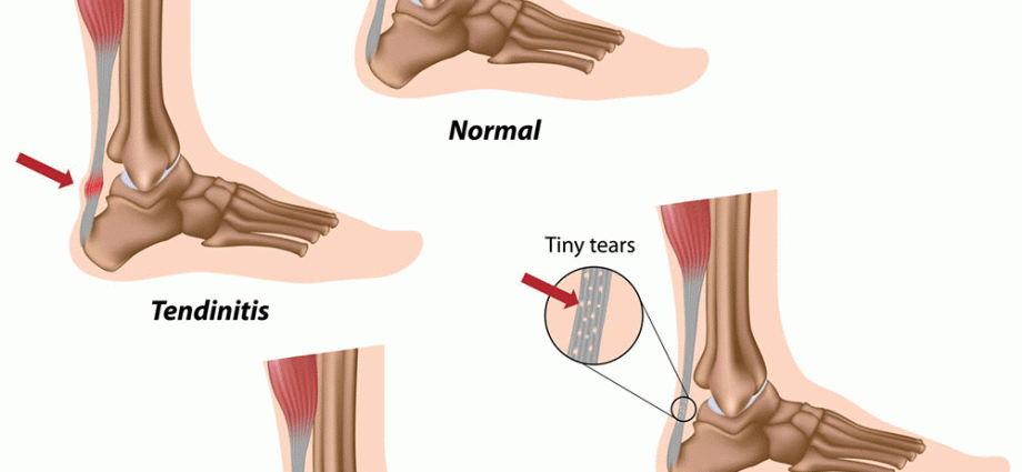 Achilles tendon injuries &#8211; symptoms, causes, diagnosis, treatment