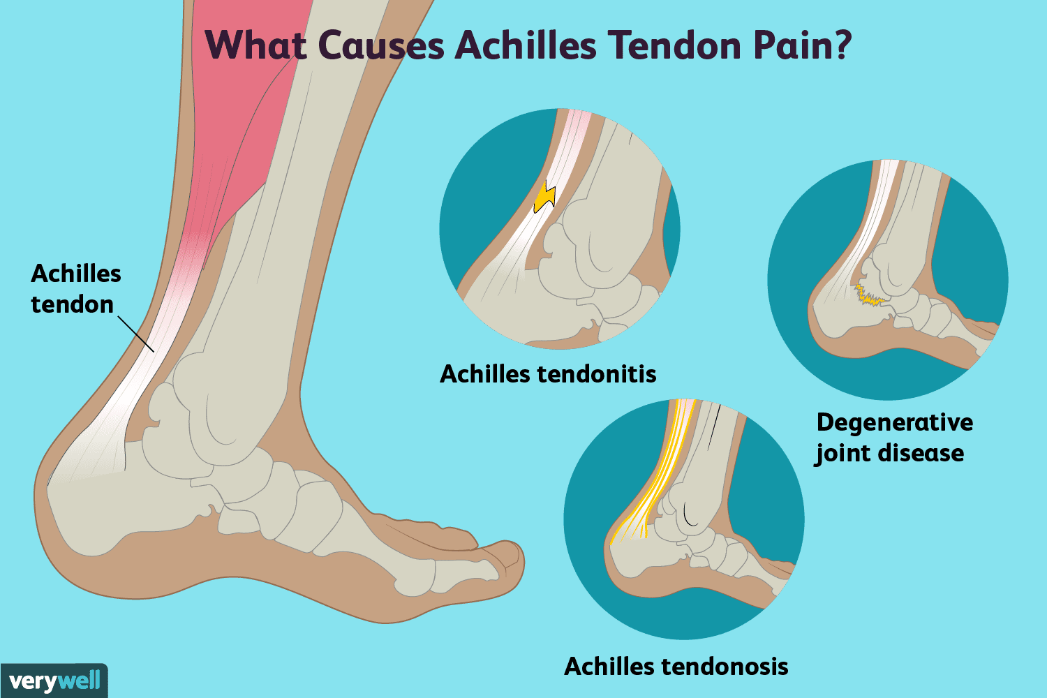 Achilles tendon pain - causes and symptoms. What to use for Achilles ...