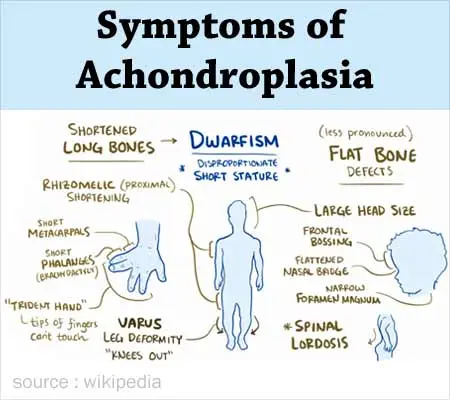 Achondroplasia &#8211; causes, symptoms, treatment