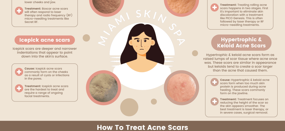 Acne scars &#8211; causes, types, treatment